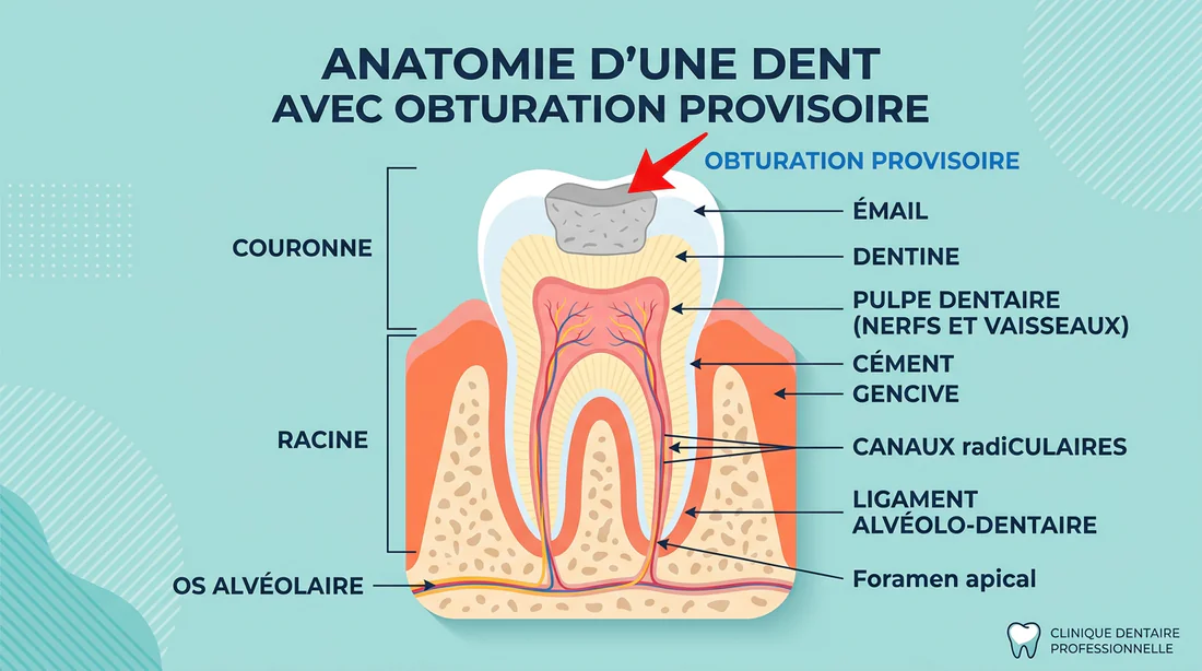 Schéma explicatif d'une dent avec un pansement dentaire